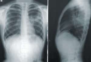 Chiropractic and x-rays
