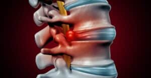 Disc Herniation